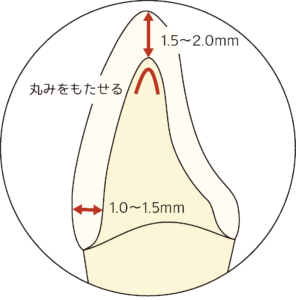 Incisal Preparation