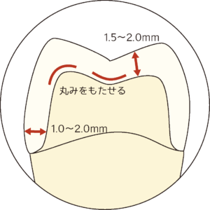Molar Preparation